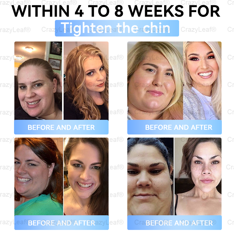Clinically Proven| Official Store | Buildleaf® Tirzepatide Slimming & Health Nano Microneedle Patch with Collagen & Matrixyl 3000丨Targets Obesity, Loose Skin, High Blood Pressure, Diabetes, Fatty Liver, Joint Pain, Brain Fog, Low Energy and More