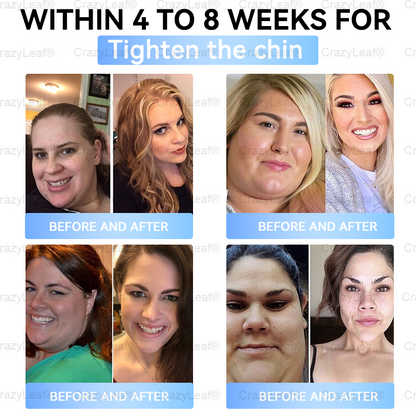 Clinically Proven| Official Store | Buildleaf® Tirzepatide Slimming & Health Nano Microneedle Patch with Collagen & Matrixyl 3000丨Targets Obesity, Loose Skin, High Blood Pressure, Diabetes, Fatty Liver, Joint Pain, Brain Fog, Low Energy and More