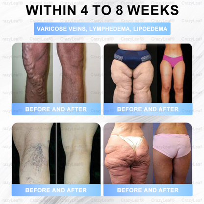 Clinically Proven| Official Store | Buildleaf® Tirzepatide Slimming & Health Nano Microneedle Patch with Collagen & Matrixyl 3000丨Targets Obesity, Loose Skin, High Blood Pressure, Diabetes, Fatty Liver, Joint Pain, Brain Fog, Low Energy and More